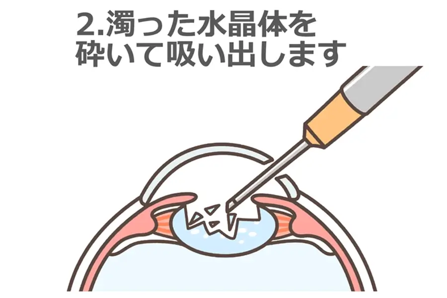 2.濁った水晶体を砕いて吸い出します