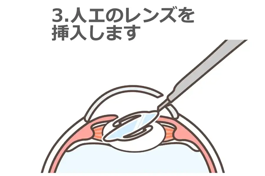3.人口のレンズを挿入します