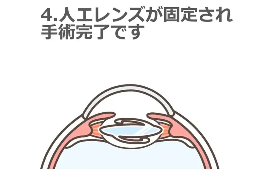 人口レンズが固定され手術完了です。